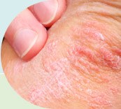 Dry Eczema