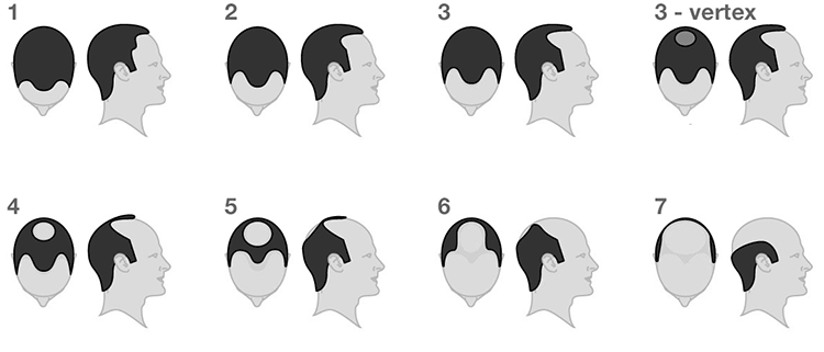 The Hamilton-Norwood stages of male pattern hair loss