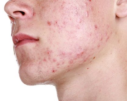 Buy antibiotics for acne online UK - Dr Fox